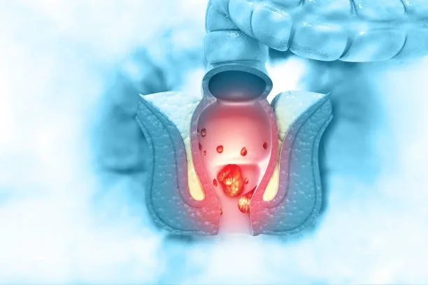 Anal cancer