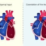 Understanding Congenital Heart Disease: A Thoughtful Aide in 2024 15 Congenital Heart Disease