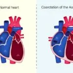 Congenital Heart Disease