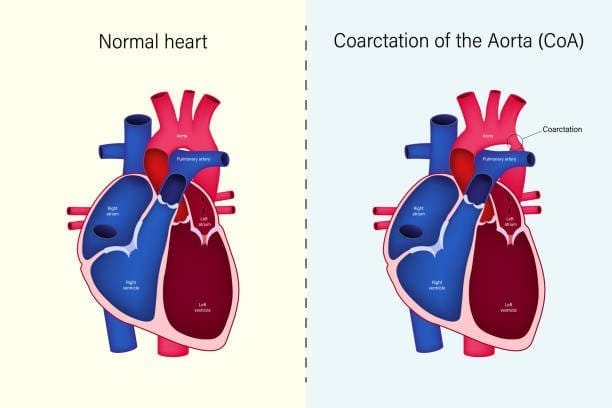 Understanding Congenital Heart Disease: A Thoughtful Aide in 2024 1 Congenital Heart Disease