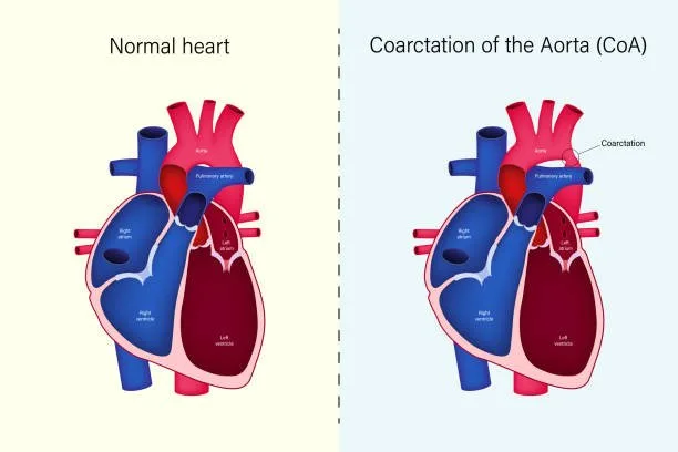 Congenital Heart Disease